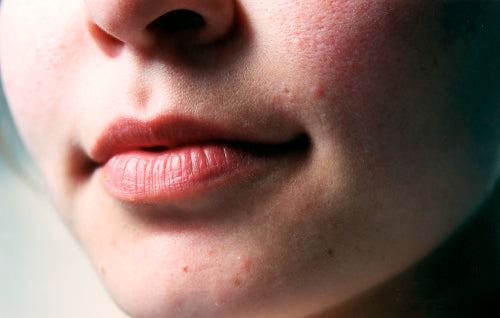 What Causes Dry and Chapped Lips
